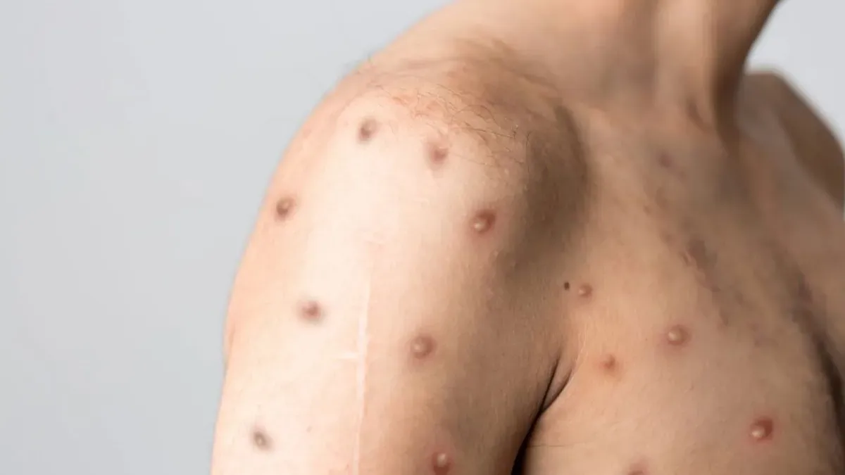 Sesab confirma dois primeiros casos de Mpox na Bahia em 2026; Salvador e Vitória da Conquista registram ocorrências